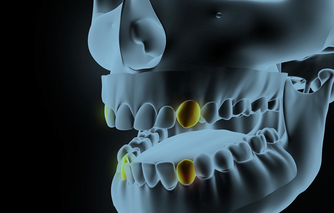 impacted canine teeth