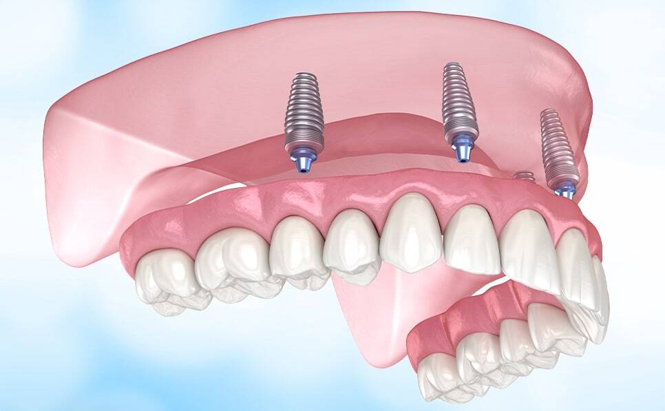 Voss Dental - Oral Surgery, Implant