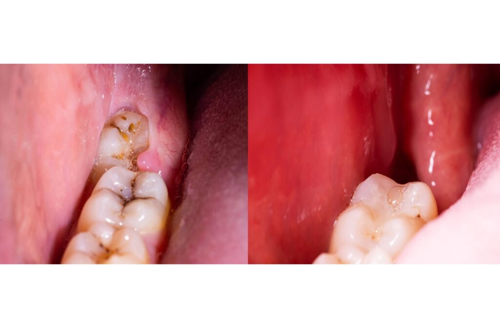 Close-up dental comparison showing a decayed wisdom tooth before treatment and the same tooth after cleaning and restoration.
