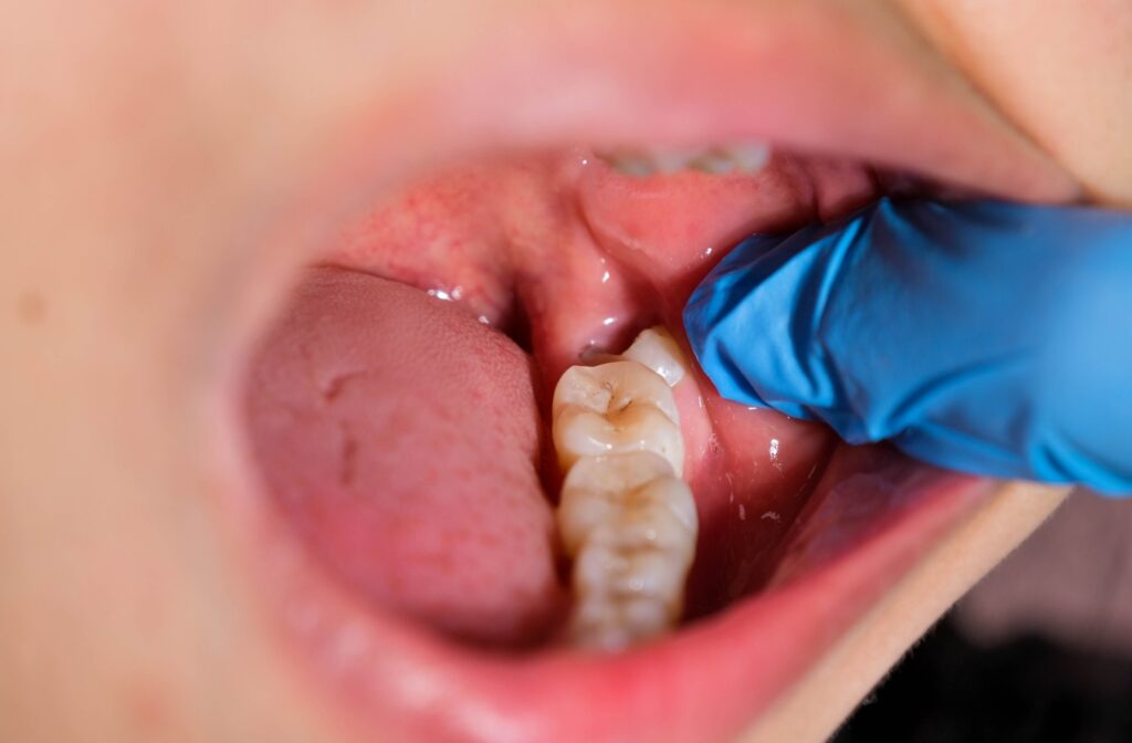 A dentist wearing blue gloves examines a patient’s partially erupted wisdom tooth inside the mouth.