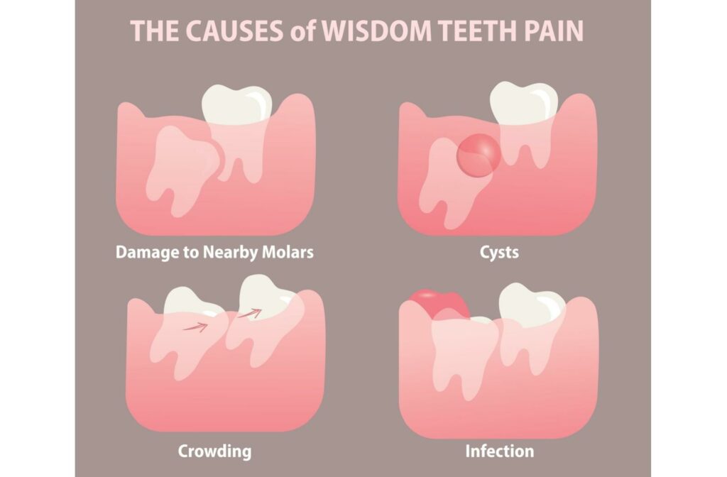 Infographic titled ‘The Causes of Wisdom Teeth Pain’ showing four illustrated gum diagrams: damage to nearby molars from an impacted tooth, a fluid-filled cyst near a wisdom tooth, crowding of teeth as a wisdom tooth pushes forward, and gum infection with redness and swelling around a partially erupted tooth.