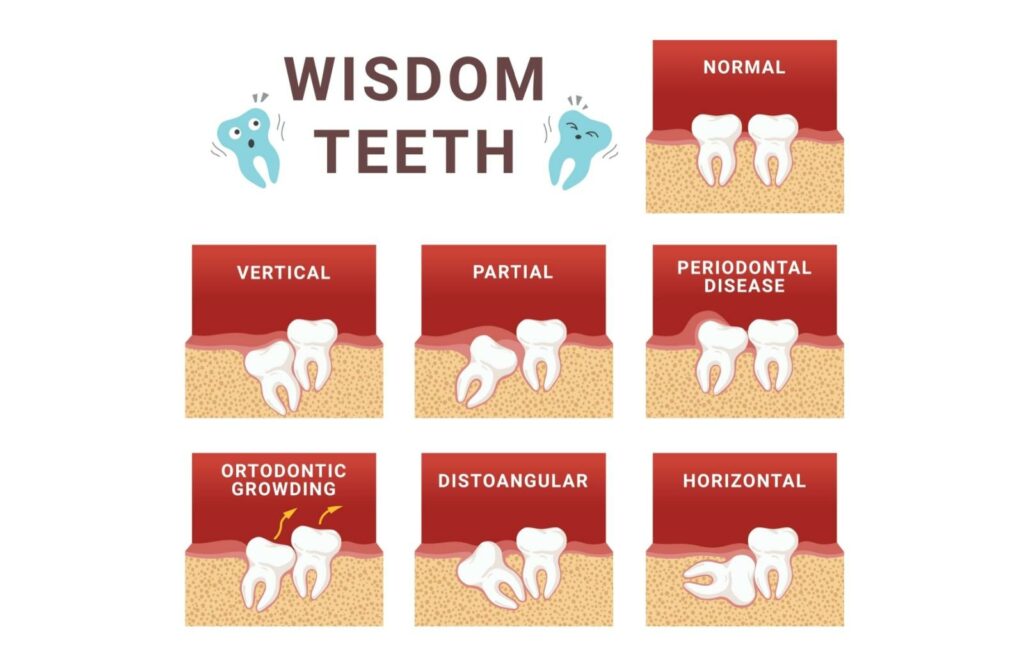 Infographic titled ‘Wisdom Teeth’ showing different positions and conditions of wisdom teeth. Panels include normal eruption, vertical impaction, partial eruption, periodontal disease affecting surrounding gums, orthodontic crowding with arrows indicating pressure, distoangular impaction (tilted backward), and horizontal impaction where the tooth lies sideways against adjacent teeth.