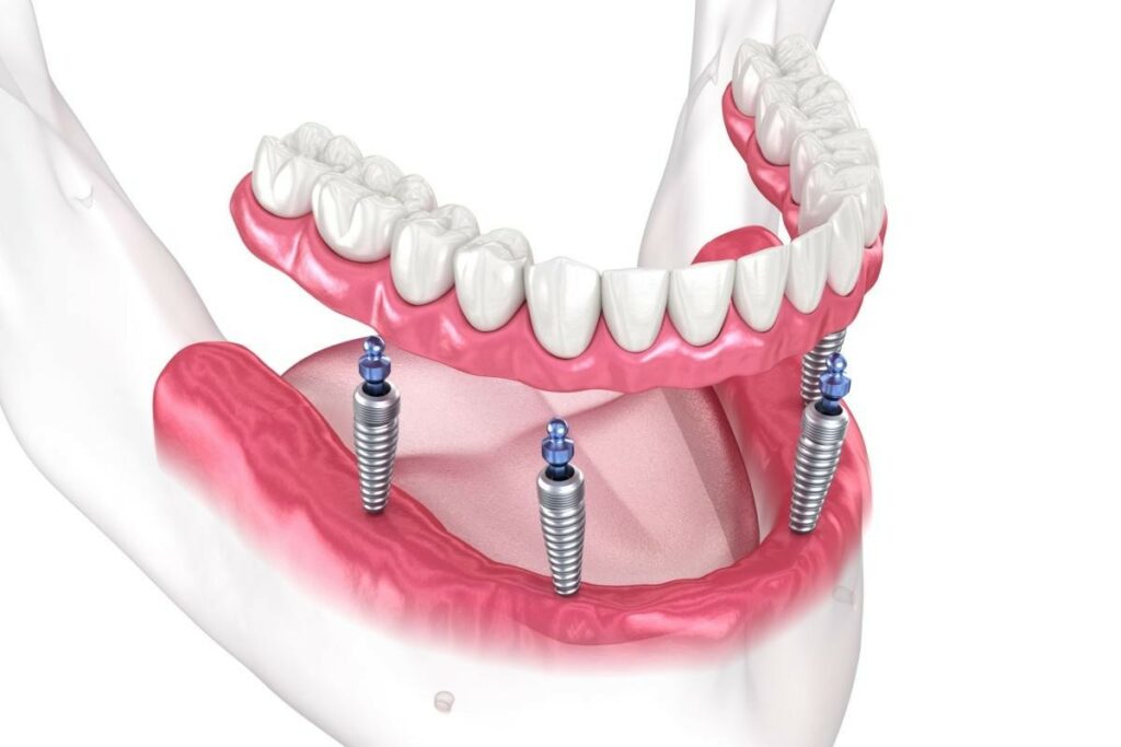 A 3D medical illustration showing a set of lower jaw dentures being attached to three dental implants anchored in the mandible, demonstrating an implant-supported prosthetic solution.